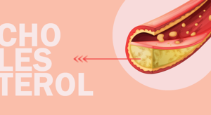 jakie są przyczyny zbyt wysokiego cholesterolu