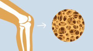 Osteoporoza. Jak pomóc sobie dietą?