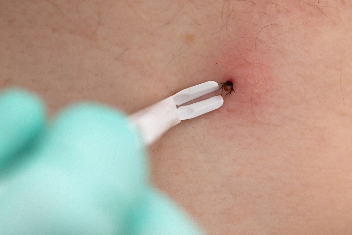 Jak wygląda rumień wędrujący? Objawy, których nie możesz lekceważyć