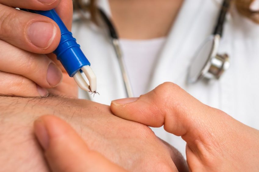 Lekarz wyjmuje kleszcza, żeby zapobiec boreliozie