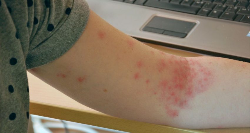 Wysypka na przedramieniu spowodowana pokrzywką alergiczną