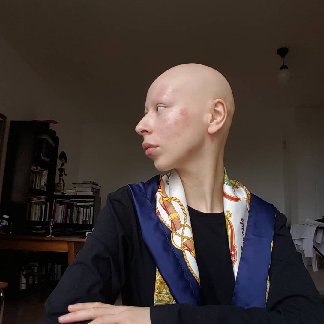 Zuzanna Bartoszek siedzi przy stole i patrzy w bok. Pokazuje rany na twarzy wywołane przez atopowe zapalenie skóry. Na szyi ma niebiesko - kremową apaszkę, jest łysa.