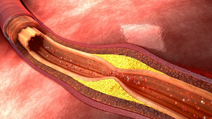 cholesterol w 3D
