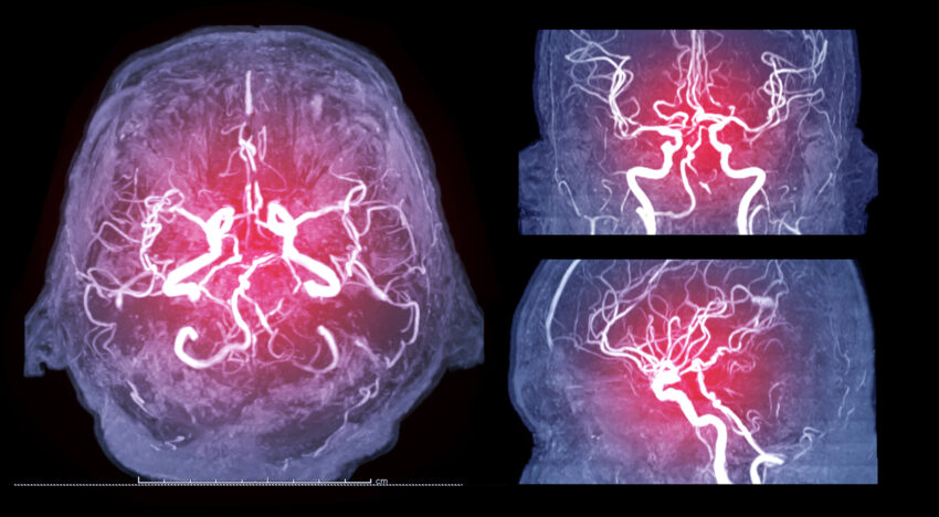 obrazów rezonansu magnetycznego (MRI) naczyń mózgowych - Hello Zdrowie