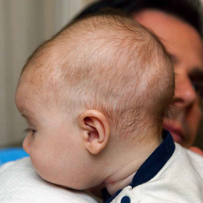 Prof. Dawid Larysz: „Niestety nadal zdarza się, że trafia do nas 9-, 10- czy 11-letnie dziecko, które ma na przykład dwa lata odroczenia szkolnego, a dopiero teraz ktoś zwrócił uwagę na nieprawidłowy kształt jego głowy” – zdjęcie numer 2 Dziecko z kraniosynostozą - Hello Zdrowie