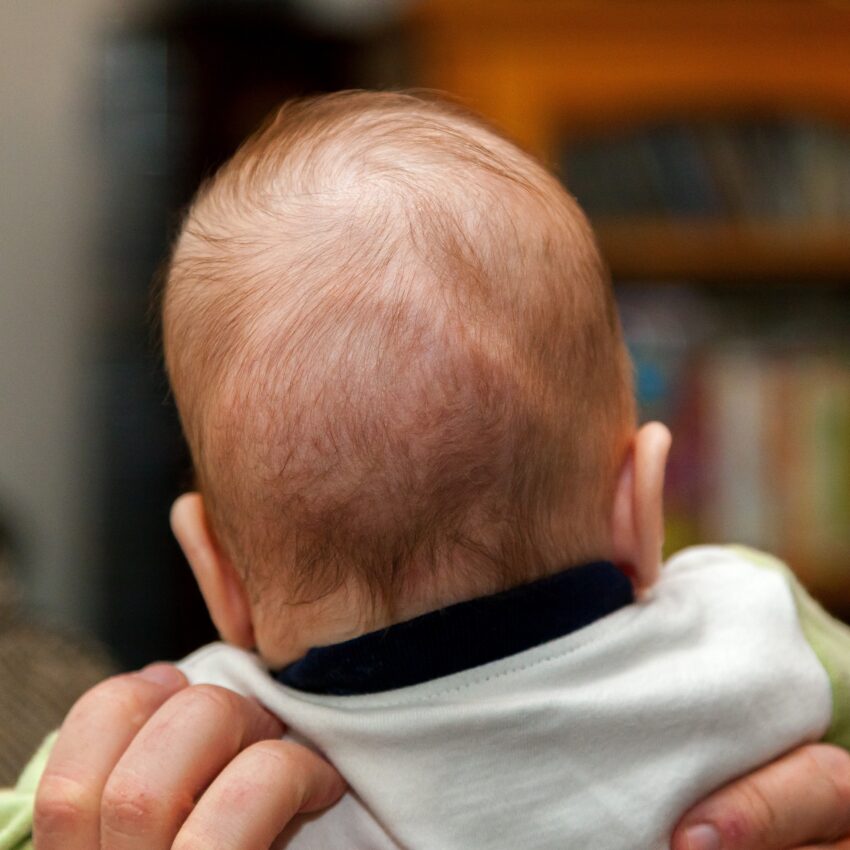 Prof. Dawid Larysz: „Niestety nadal zdarza się, że trafia do nas 9-, 10- czy 11-letnie dziecko, które ma na przykład dwa lata odroczenia szkolnego, a dopiero teraz ktoś zwrócił uwagę na nieprawidłowy kształt jego głowy” – zdjęcie numer 3 Dziecko z kraniosynostozą - Hello Zdrowie