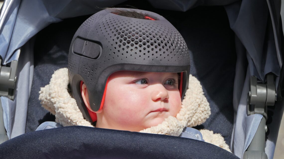 Dziewczynka z kraniosynostozą w kasku do modelowania kształtu głowy - Hello Zdrowie