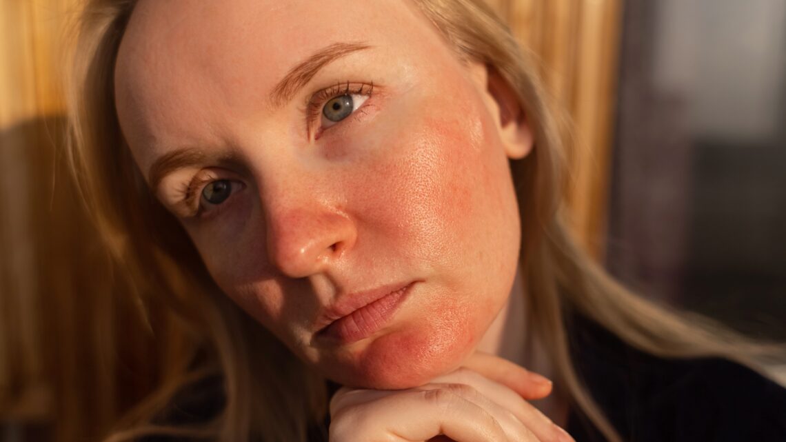 na zdjęciu: kobieta z zaczerwienionymi policzkami i brodą - Hello Zdrowie