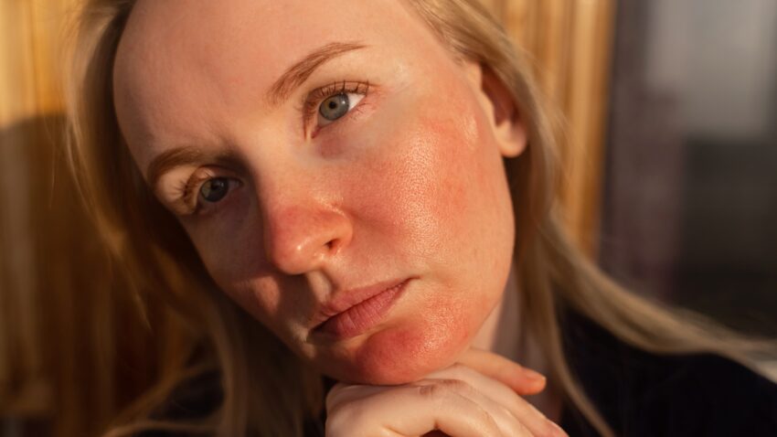 na zdjęciu: kobieta z zaczerwienionymi policzkami i brodą - Hello Zdrowie